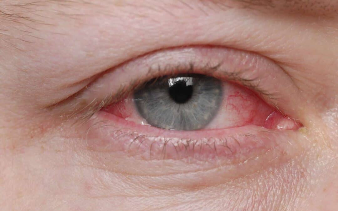 conjunctivitis-pink-eye