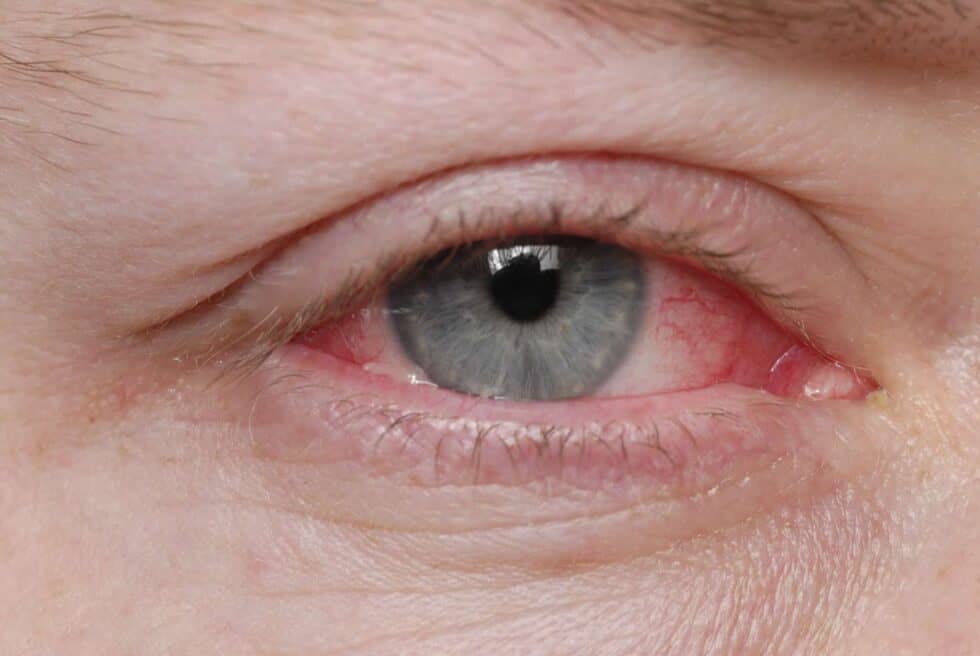 Conjunctivitis Pink Eye Bc Doctors Of Optometry